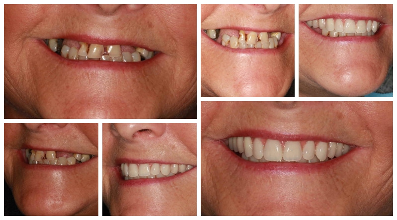 Before & After Dental Implants
