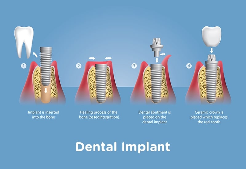 what is a dental implant and how do they work?