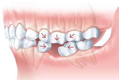 forces on teeth