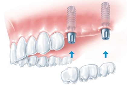 Multiple Missing Teeth