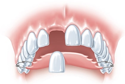 Example of a partial denture