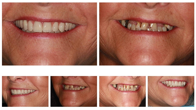 Before & After Dental Implants