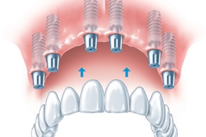 Same day teeth