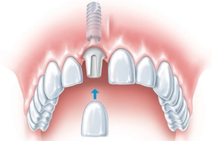 Single Dental Implant