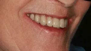 Lynn Smile After