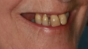 Lynn Smile Before