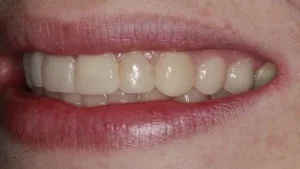 Miss F Smile After