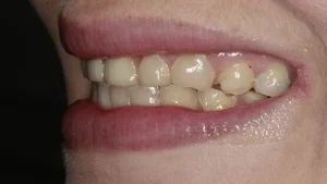 Miss F Smile Before