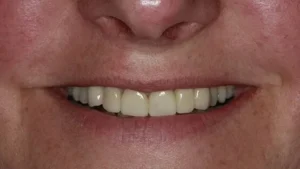 Mrs W Smile After