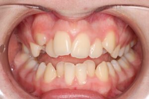 Puredentalhealth Ortho Before