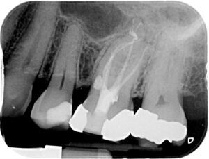 Puredentalhealth Root Canal After