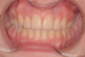 Puredentalheatlh Ortho After