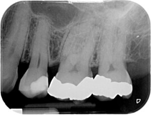 Puredentalheatlh Root Canal Before