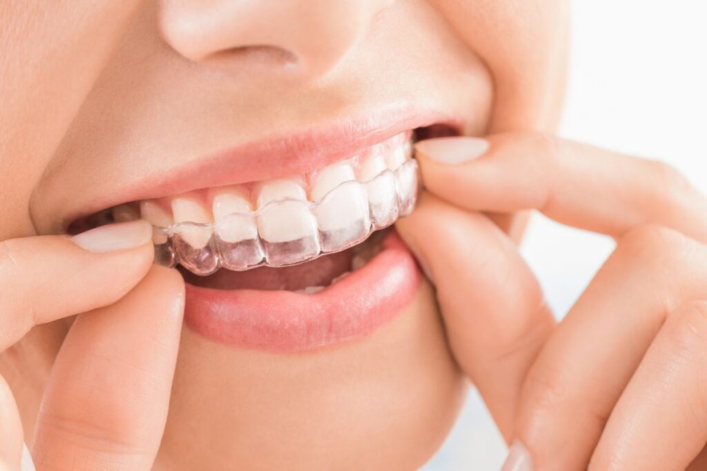 Invisalign Aligners