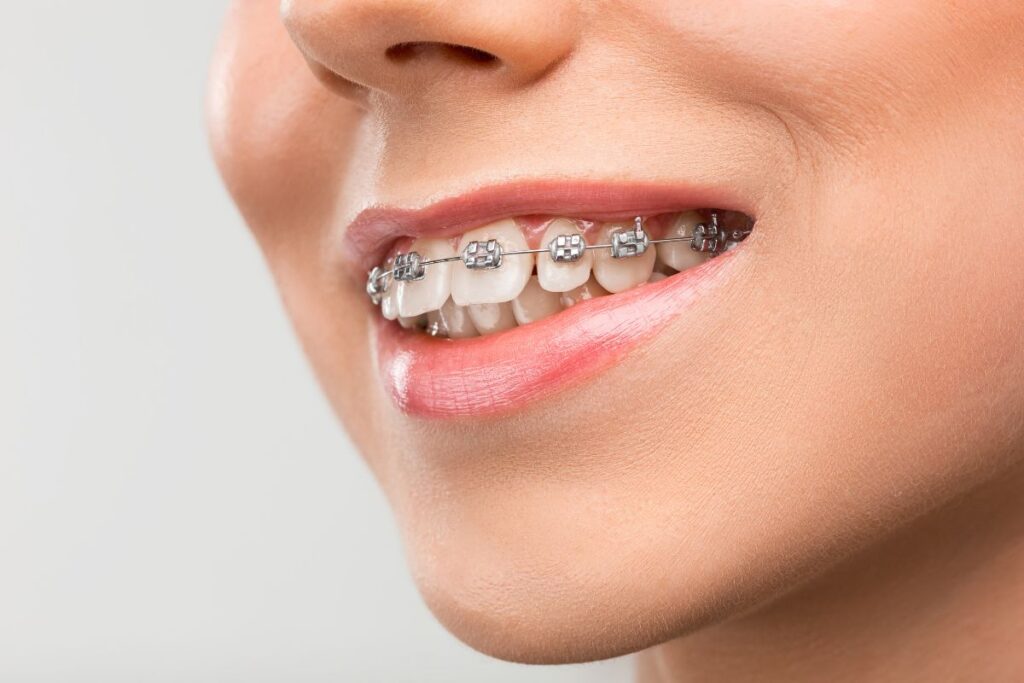 Metal Braces