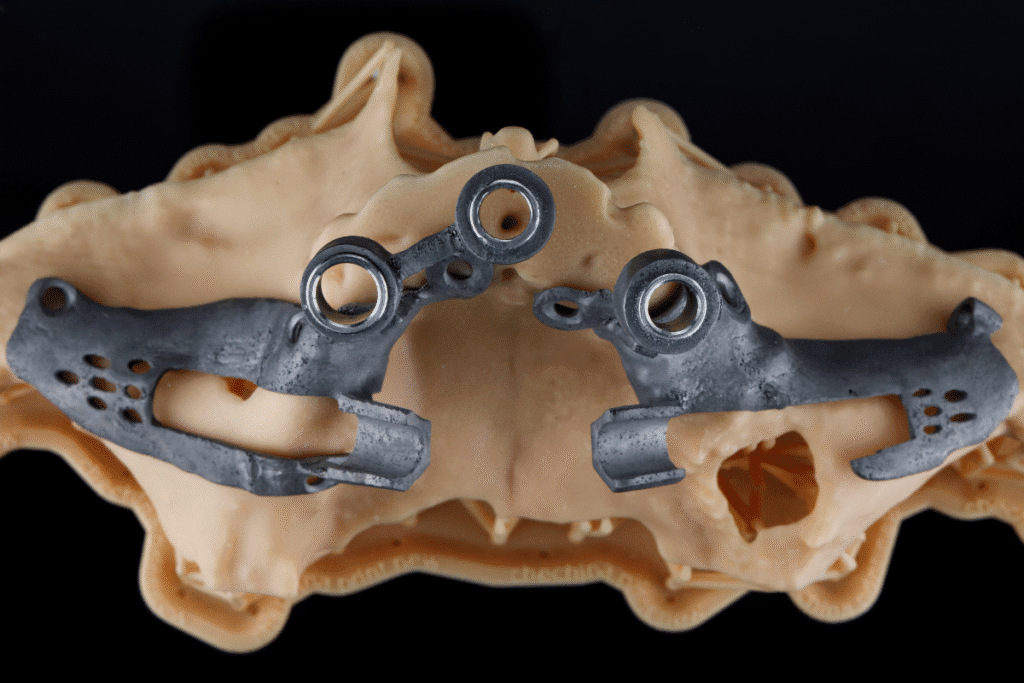 Different Types Of Dental Implants Zygomatic Implants