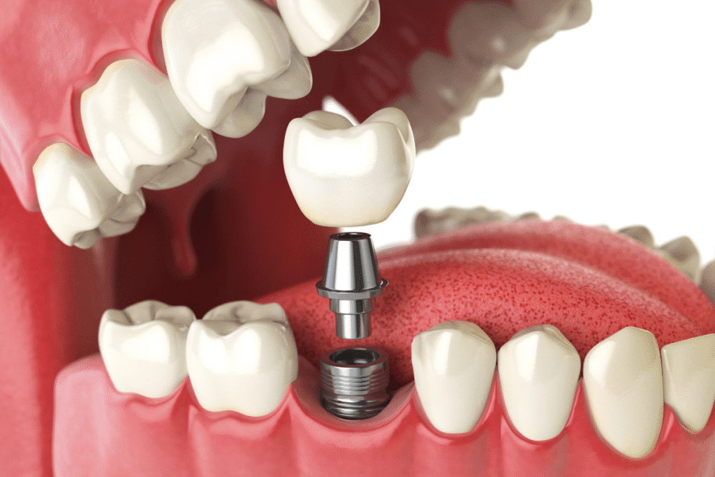 Different Types Of Dental Implants Explained