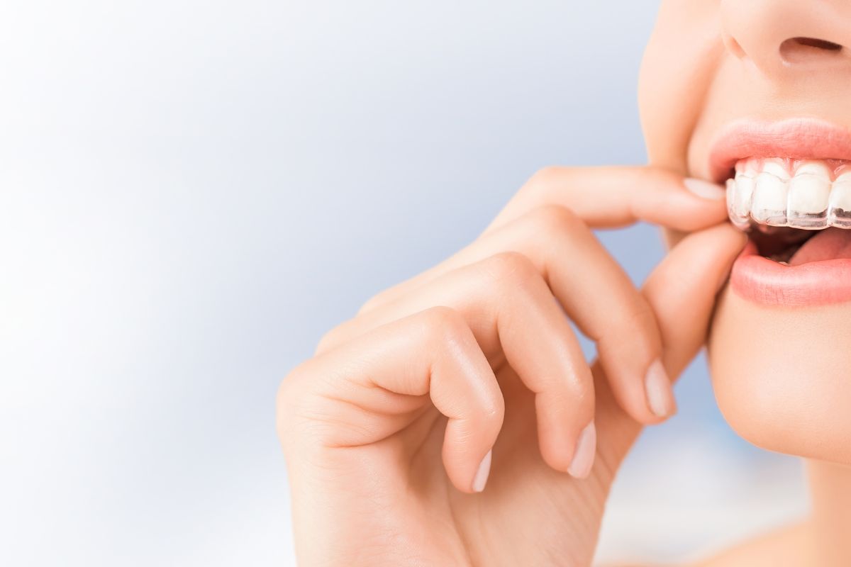 Does Invisalign really Work? Find out in our guide