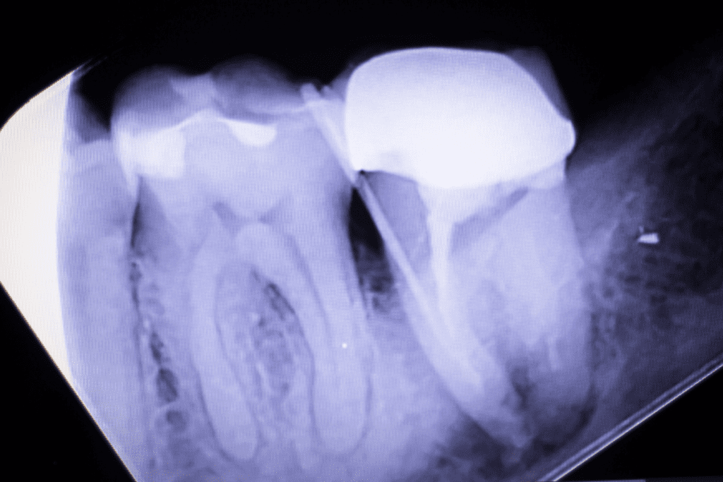X Ray Of Root Canal And Tooth Abscess Stages