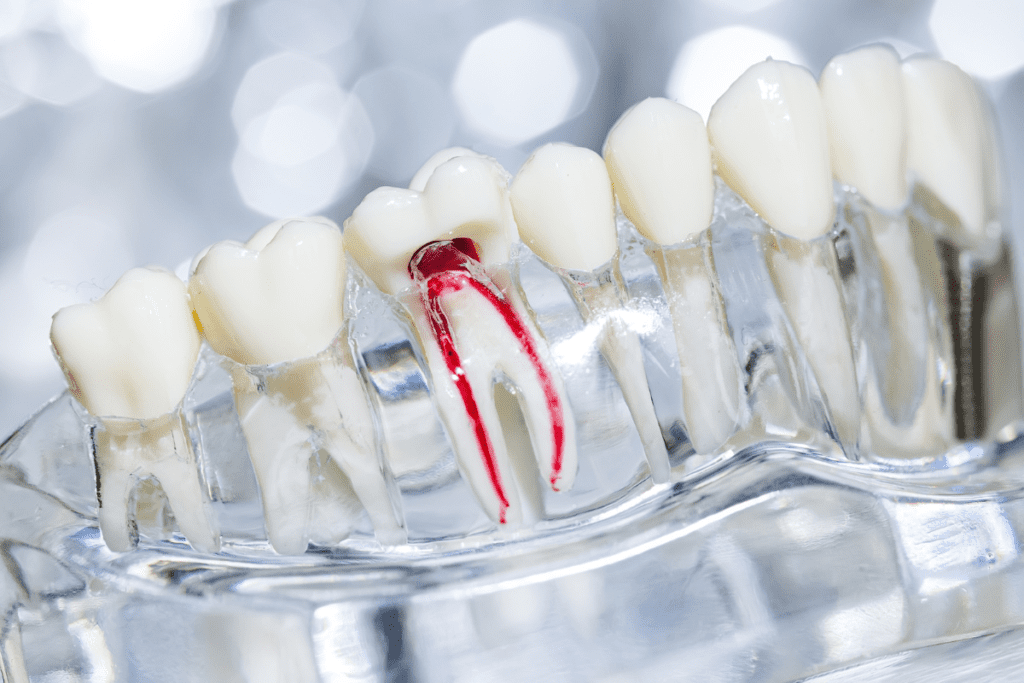 Signs Of Needing A Root Canal