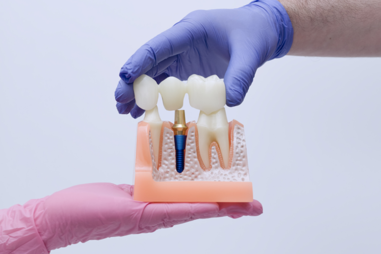 Dental Bridges vs Implants - Which Is Best For You