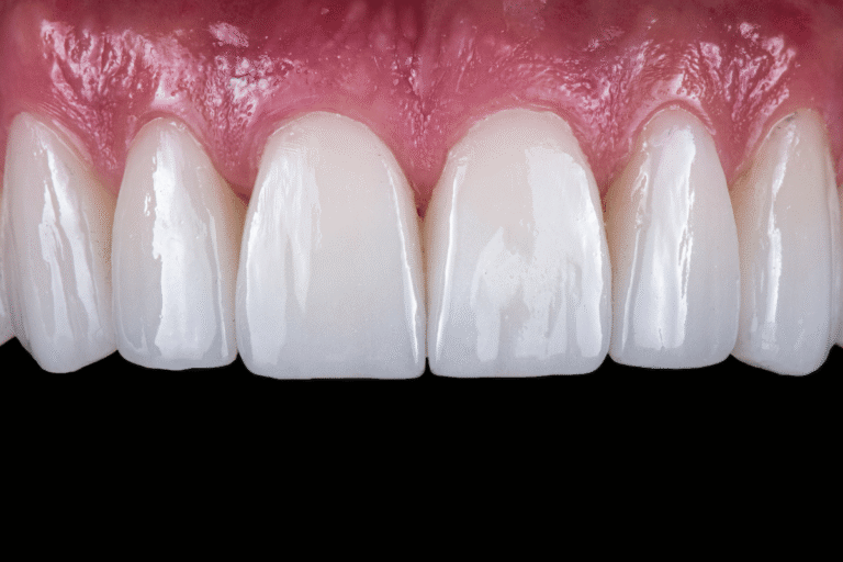 Composite Bonding Vs Veneers Which Should You Choose