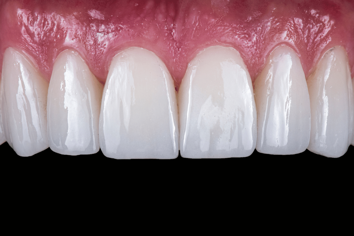 Composite Bonding Vs Veneers Which Should You Choose