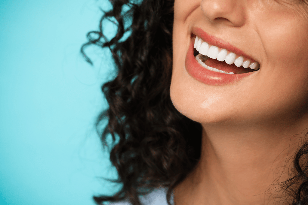 Comparing Composite Bonding Vs Veneers
