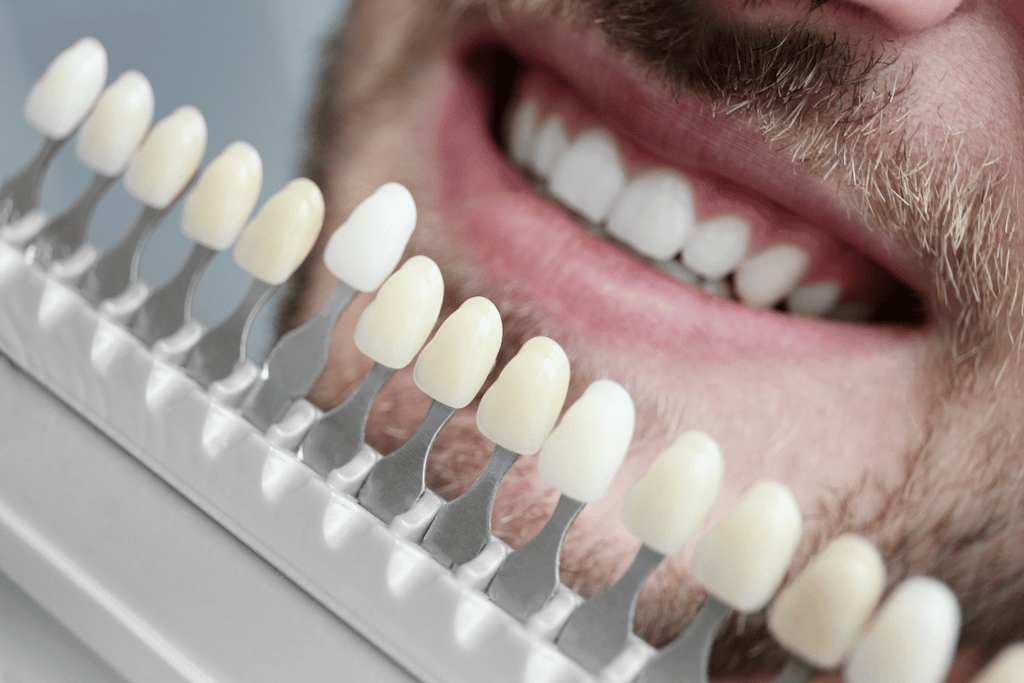 How To Choose Bonding Or Veneers