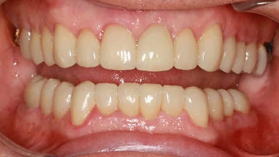 after dental crowns