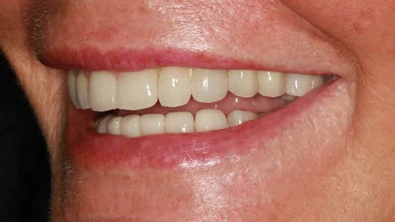 after dental implants