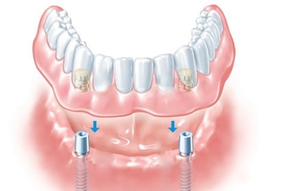 Denture Stabilisation