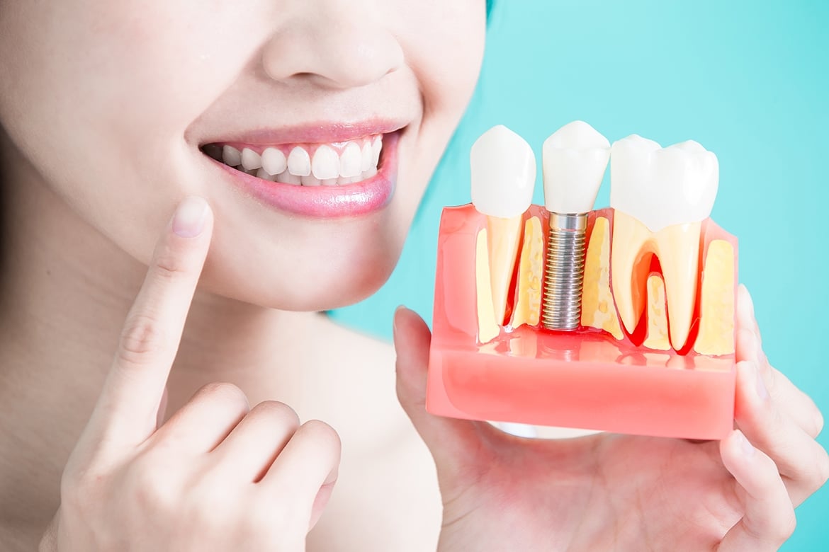 What are Dental Implants? - Types of Dental Implants